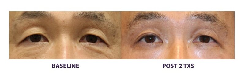 Before and after photos of Zula Modern Medspa sagging skin treatment patient