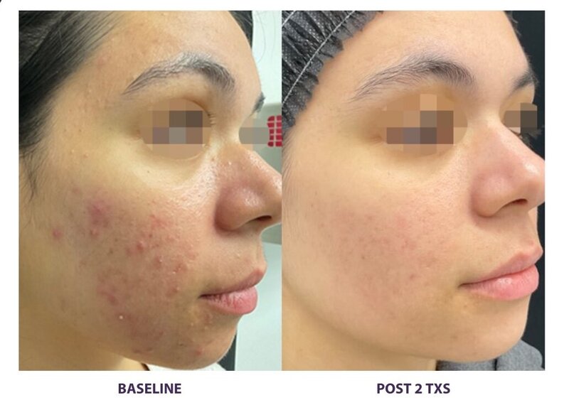 Before and after photos of Zula Modern Medspa discoloration treatment patient