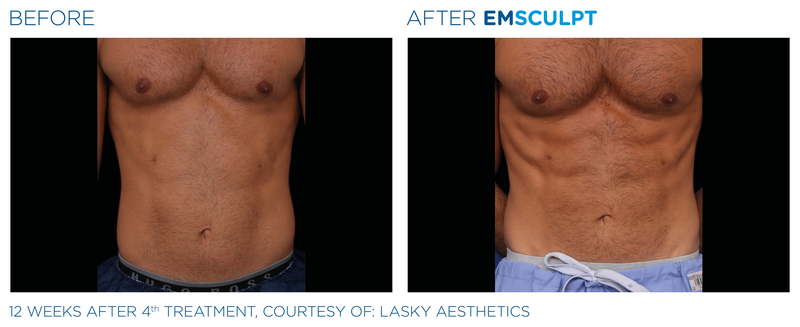 Emsculpt_PIC_Ba-card-male-abdomen-061_ENUS100
