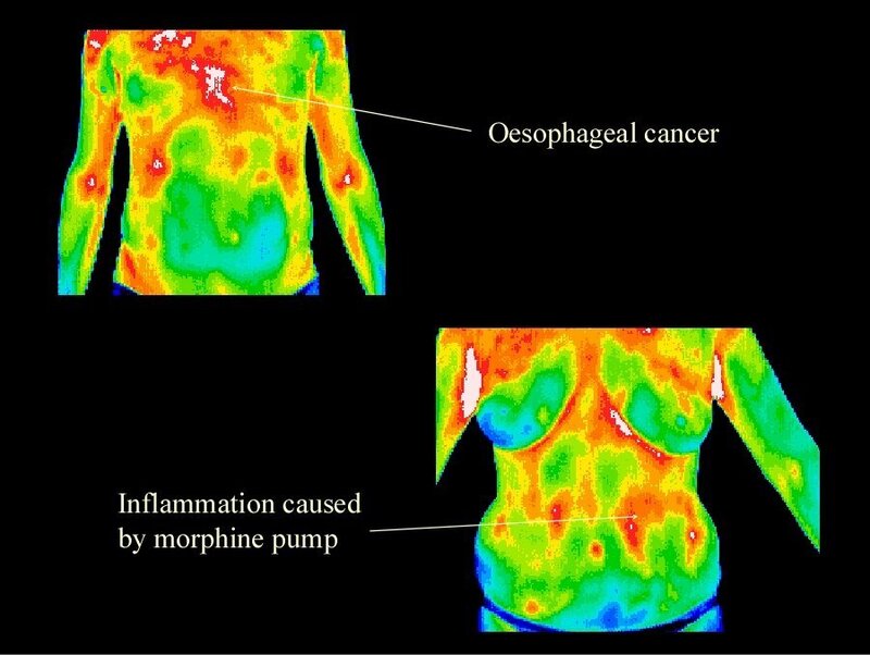 Oesophogeal Cancer