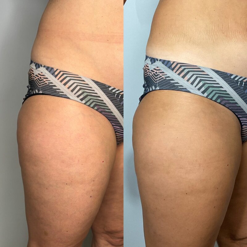 Before and after photos of Zula Modern Medspa cellulite treatment patient