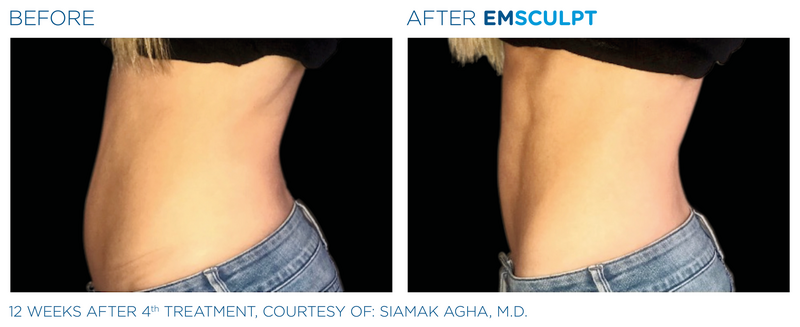 Emsculpt_PIC_Ba-card-female-abdomen-096_ENUS100