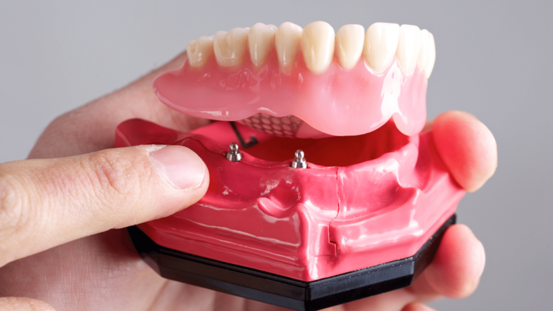 a dentist holds a set of Implant-supported dentures