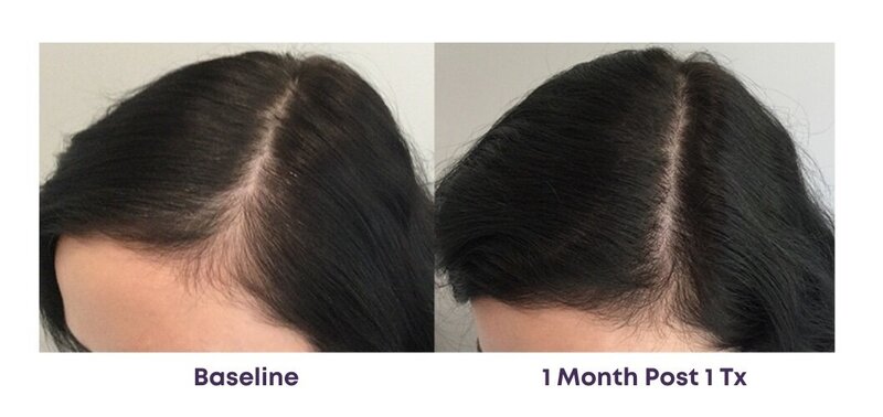Before and after photos of Zula Modern Medspa hair thinning treatment patient