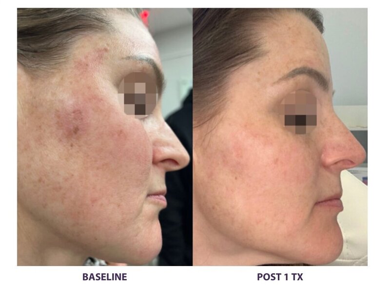 Before and after photos of Zula Modern Medspa anti-aging treatment patient