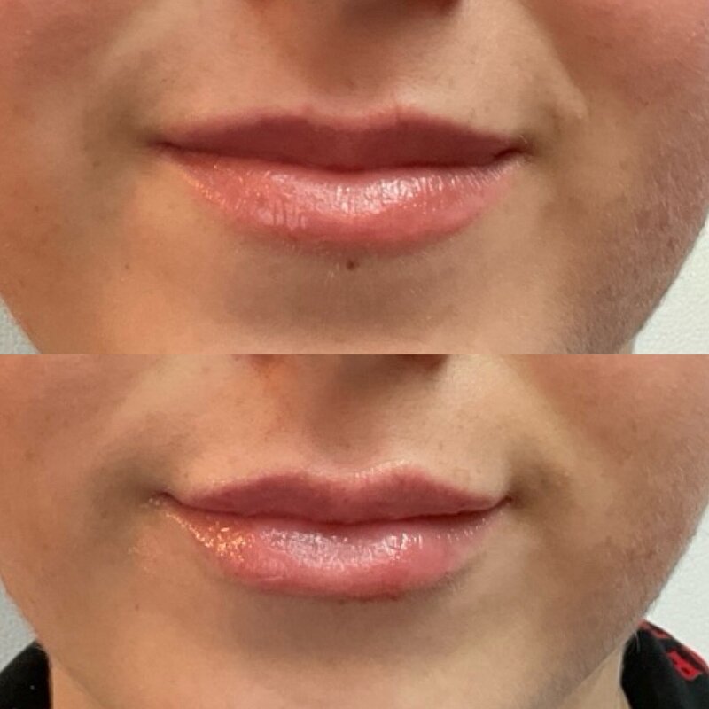 Before and after photos of Zula Modern Medspa volume loss treatment patient