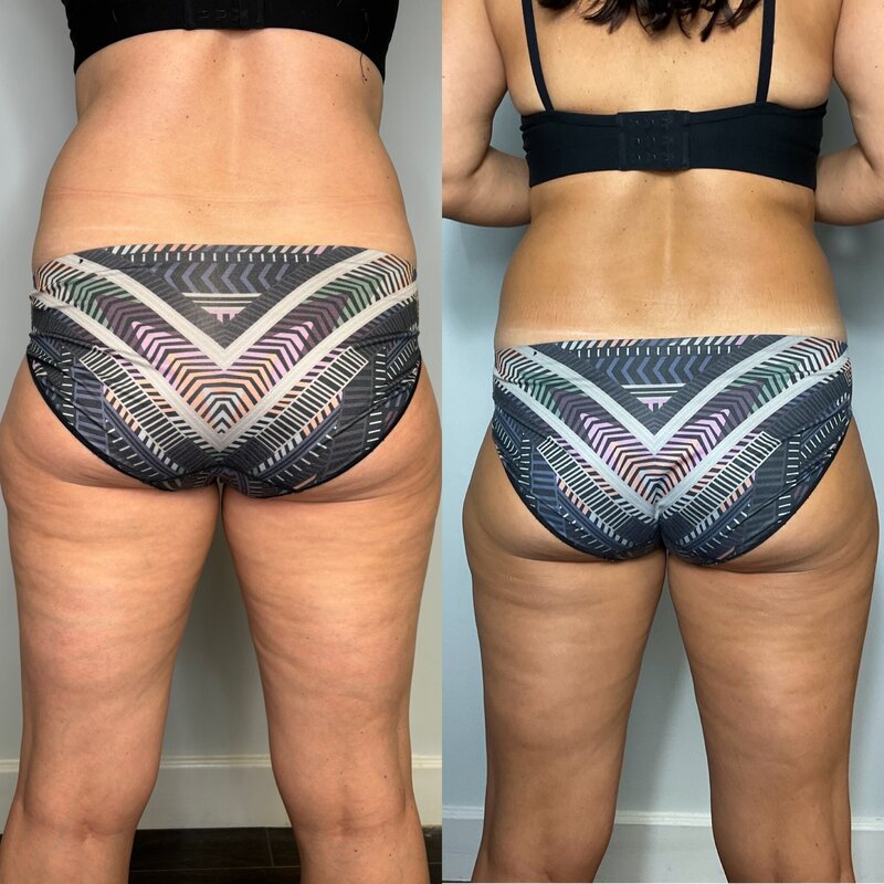 Before and after photos of Zula Modern Medspa cellulite treatment patient