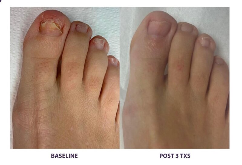 Before and after photos of Zula Modern Medspa toenail fungus treatment patient