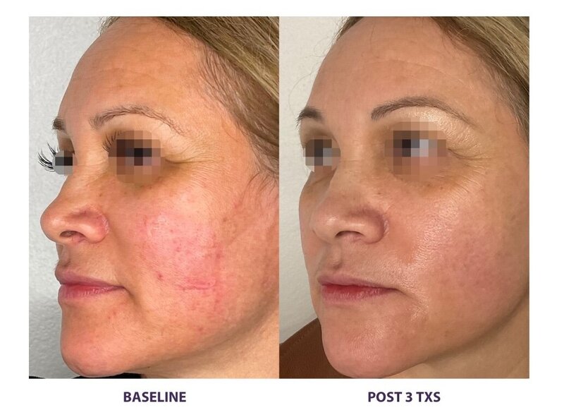 Before and after photos of Zula Modern Medspa rosacea treatment patient