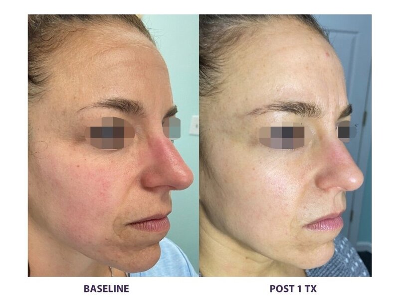 Before and after photos of Zula Modern Medspa rosacea treatment patient