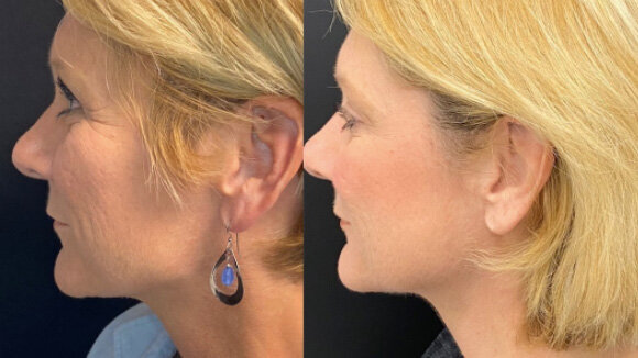 Beauty and Grace Aesthetics microneedling patient before and after