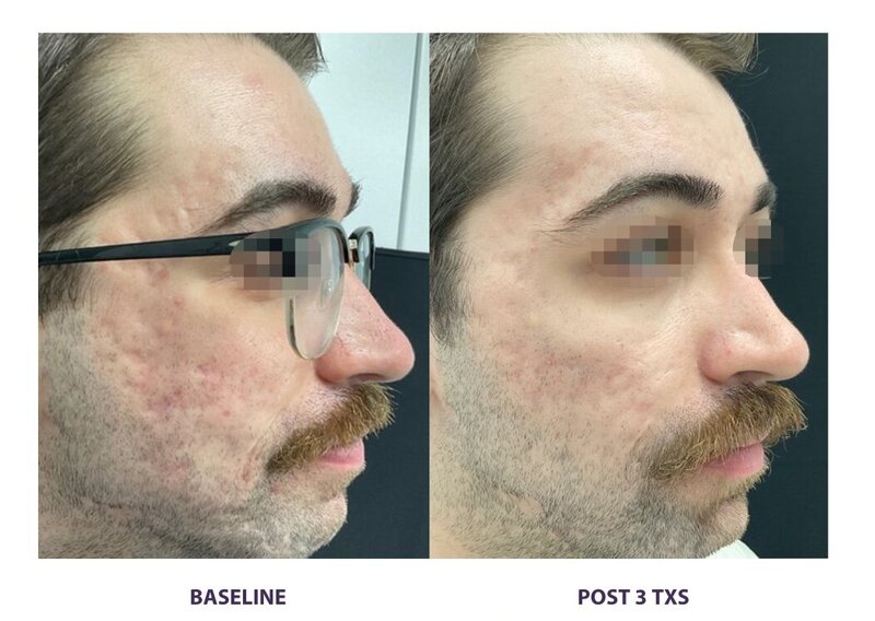 Before and after photos of Zula Modern Medspa acne treatment patient