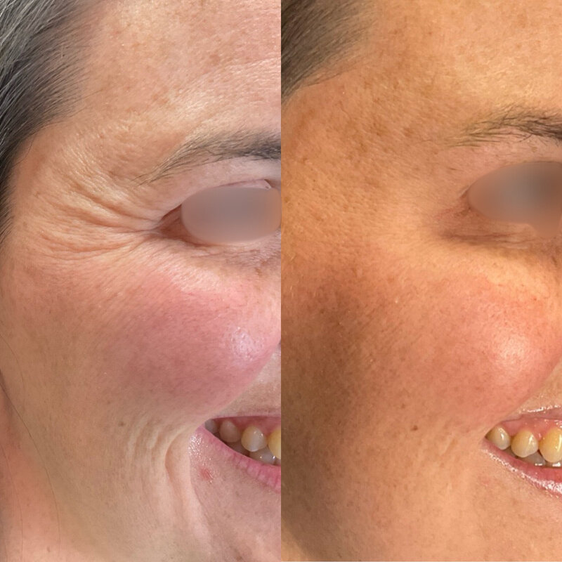 Before and after photos of Zula Modern Medspa botox treatment patient