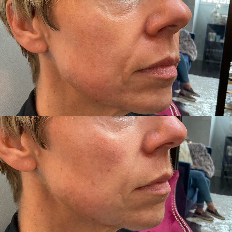 Before and after photos of Zula Modern Medspa sagging skin treatment patient
