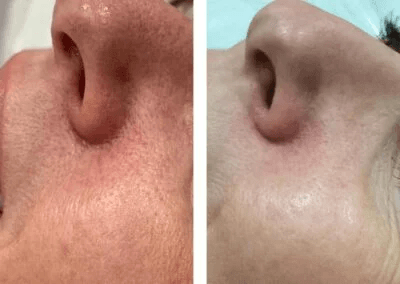 Thread-Vein-removal-with-Thermavein-around-nose-400x284