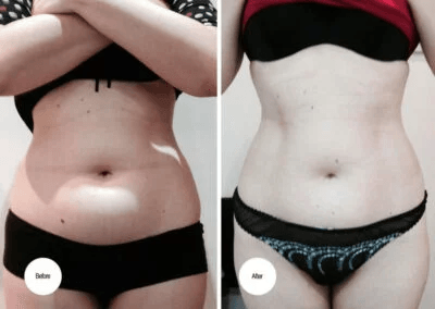 LipoContrast-Duo-before-and-after-tummy-belly-abdomen-flanks-400x284