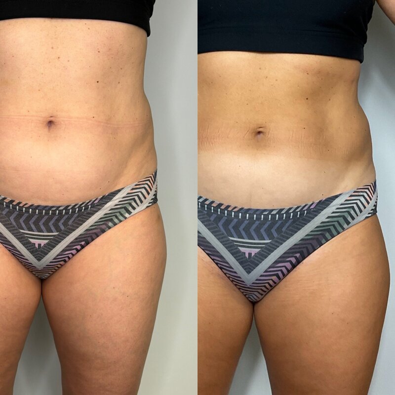 Before and after photos of Zula Modern Medspa stretch mark treatment patient
