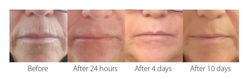 Before and after photos of Zula Modern Medspa sagging skin treatment patient