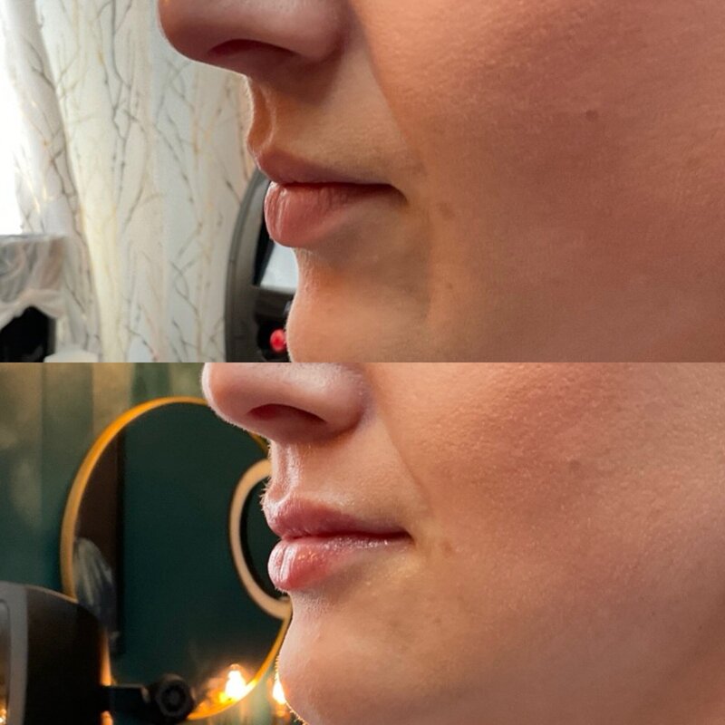 Before and after photos of Zula Modern Medspa volume loss treatment patient