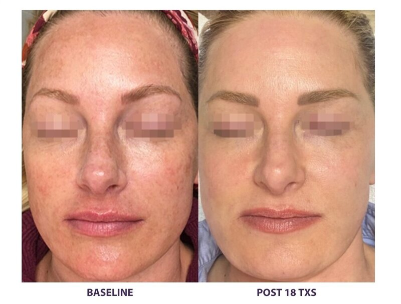 Before and after photos of Zula Modern Medspa discoloration treatment patient