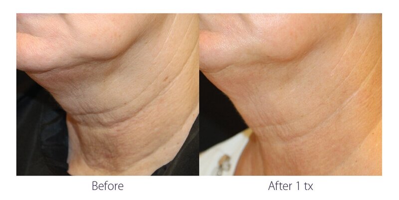 Before and after photos of Zula Modern Medspa double chin treatment patient