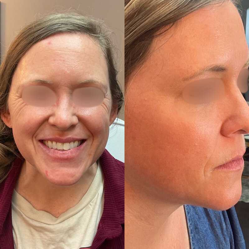 Before and after photos of Zula Modern Medspa botox treatment patient