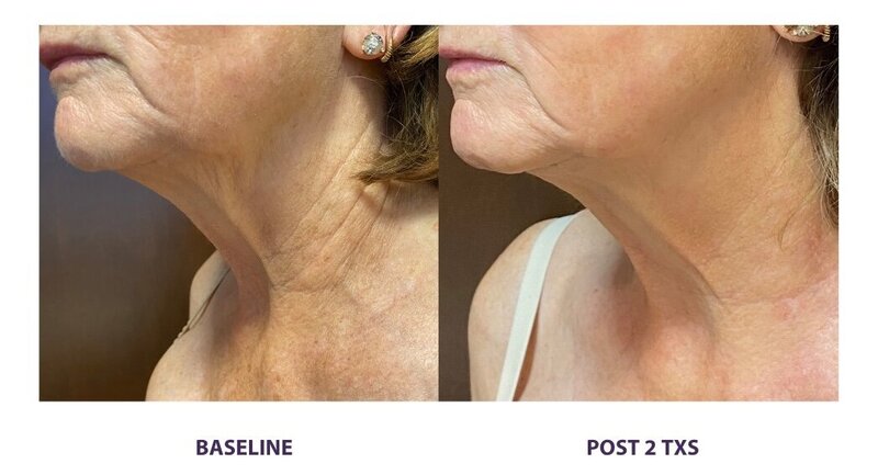 Before and after photos of Zula Modern Medspa wrinkle and fine line treatment patient