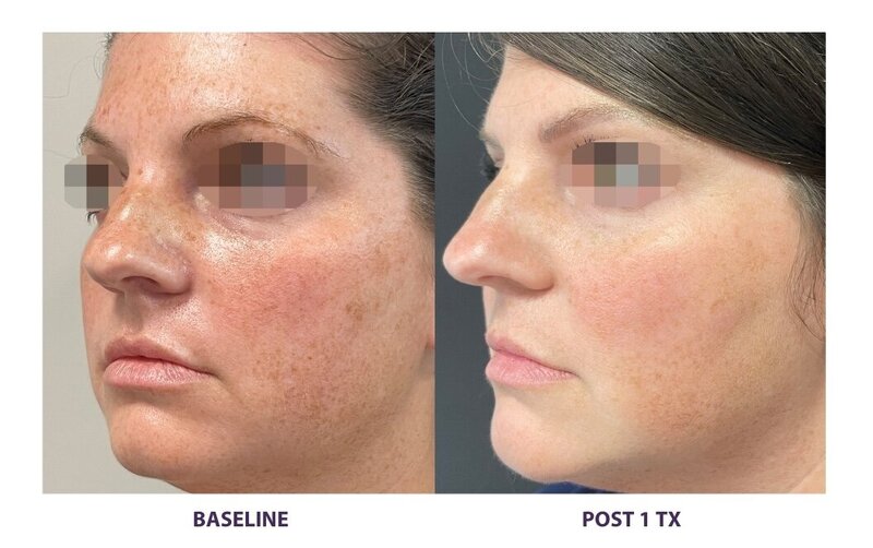 Before and after photos of Zula Modern Medspa anti-aging treatment patient