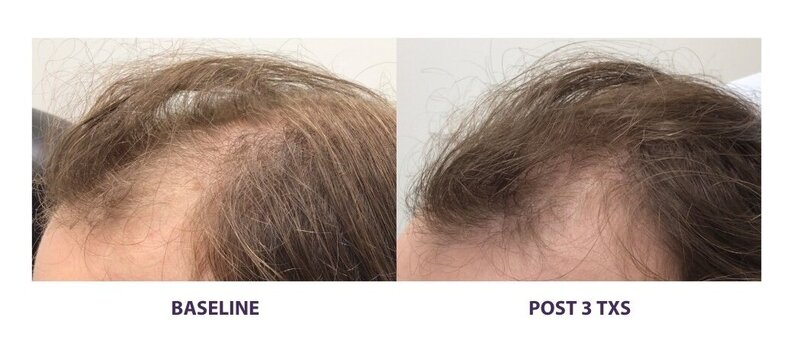 Before and after photos of Zula Modern Medspa hair thinning treatment patient