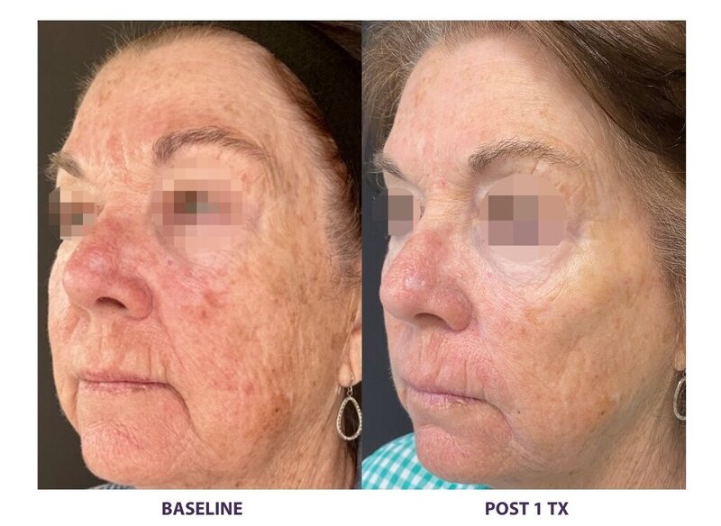 Before and after photos of Zula Modern Medspa discoloration treatment patient
