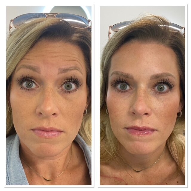 Beauty and Grace Aesthetics Botox patient before and after