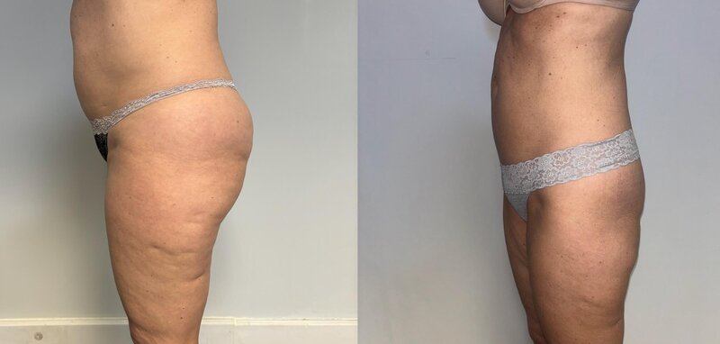 Before and after photos of Zula Modern Medspa cellulite treatment patient