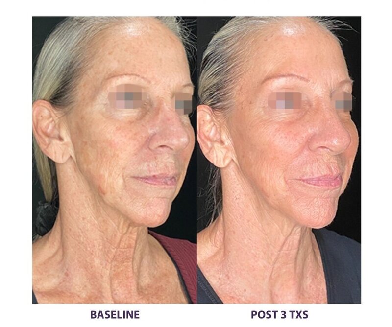 Before and after photos of Zula Modern Medspa anti-aging treatment patient