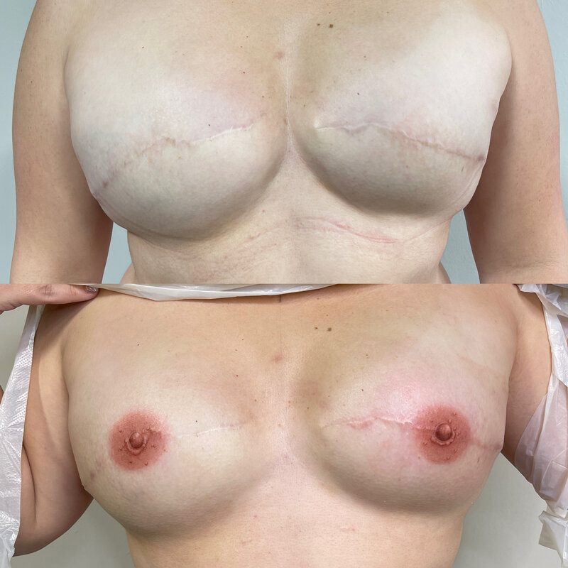 Before and after image of 3D areola tattoos done by Shaunna Nunes in Sacramento, Ca