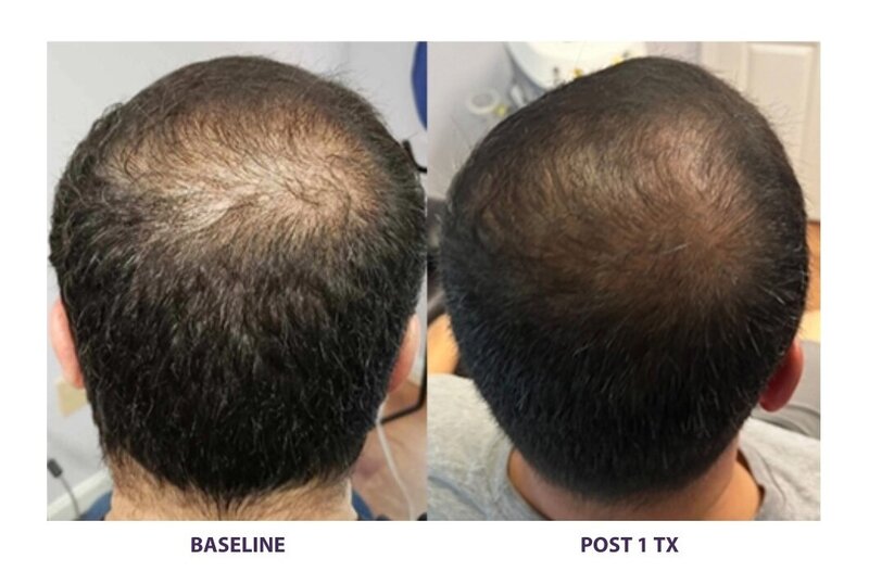Before and after photos of Zula Modern Medspa hair thinning treatment patient