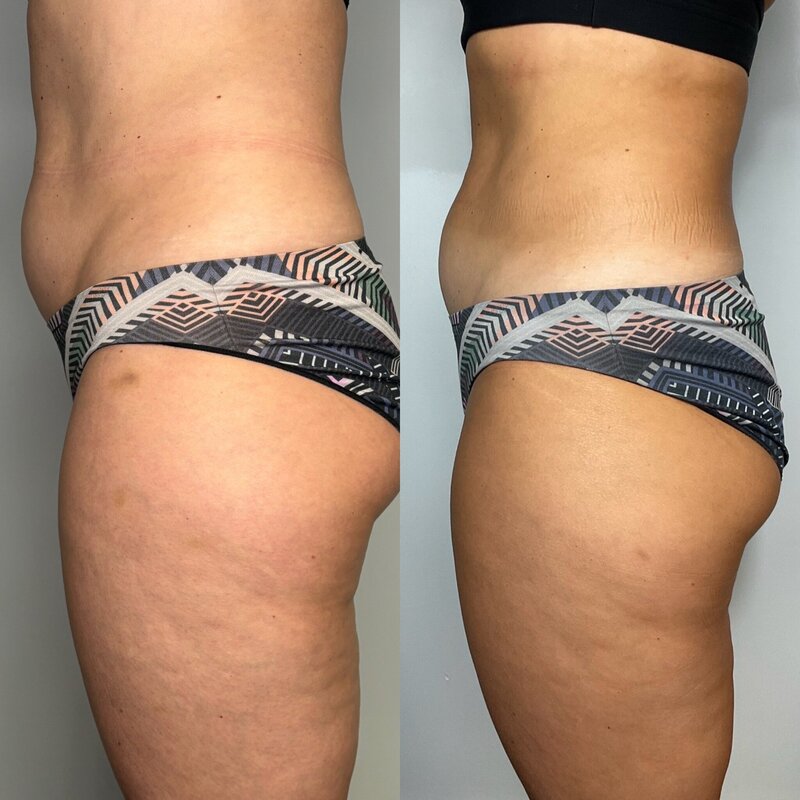 Before and after photos of Zula Modern Medspa stretch mark treatment patient