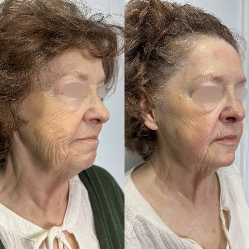 Before and after photos of Zula Modern Medspa volume loss treatment patient