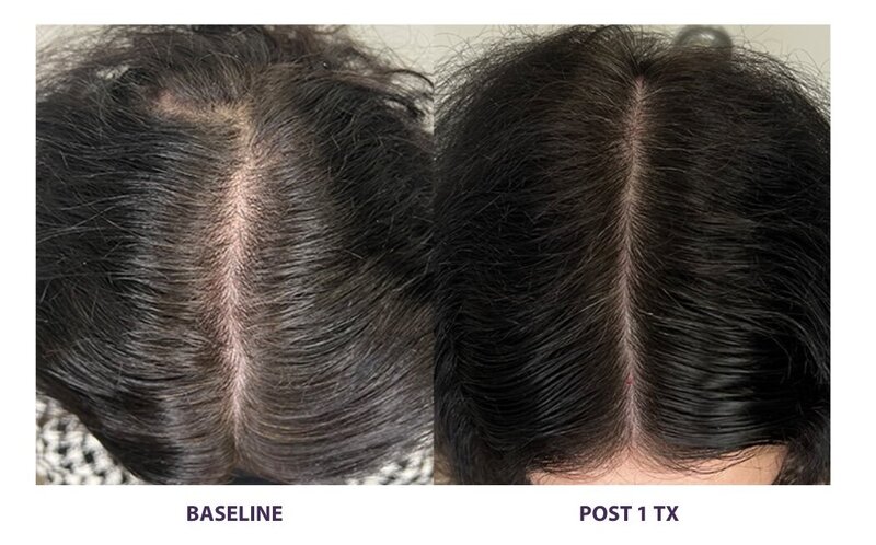 Before and after photos of Zula Modern Medspa hair thinning treatment patient