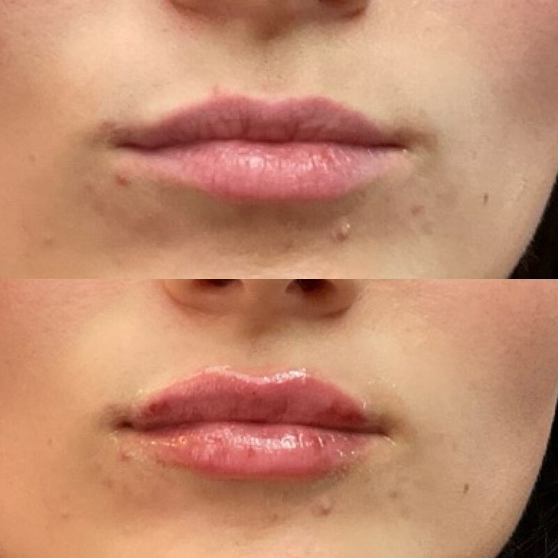 Before and after photos of Zula Modern Medspa volume loss treatment patient
