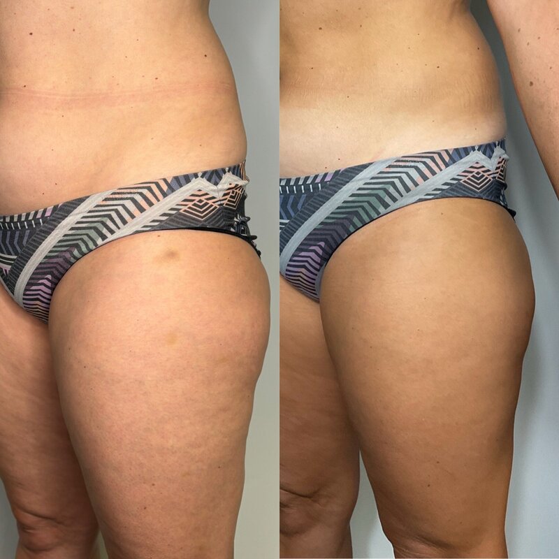 Before and after photos of Zula Modern Medspa cellulite treatment patient