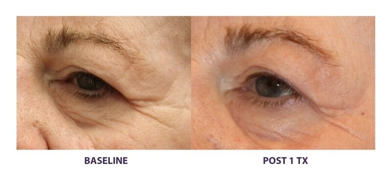 Before and after photos of Zula Modern Medspa wrinkle and fine line treatment patient
