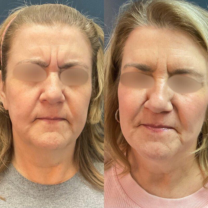 Before and after photos of Zula Modern Medspa wrinkle and fine line treatment patient