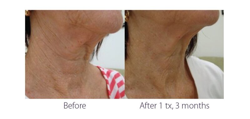 Before and after photos of Zula Modern Medspa sagging skin treatment patient