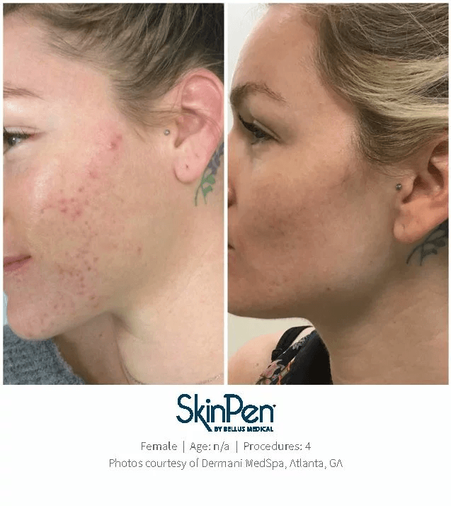 Skin-Pen-acne-scar-before-and-after-3