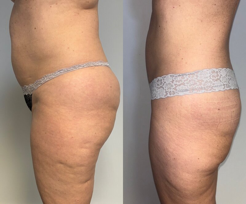 Before and after photos of Zula Modern Medspa fat loss treatment patient
