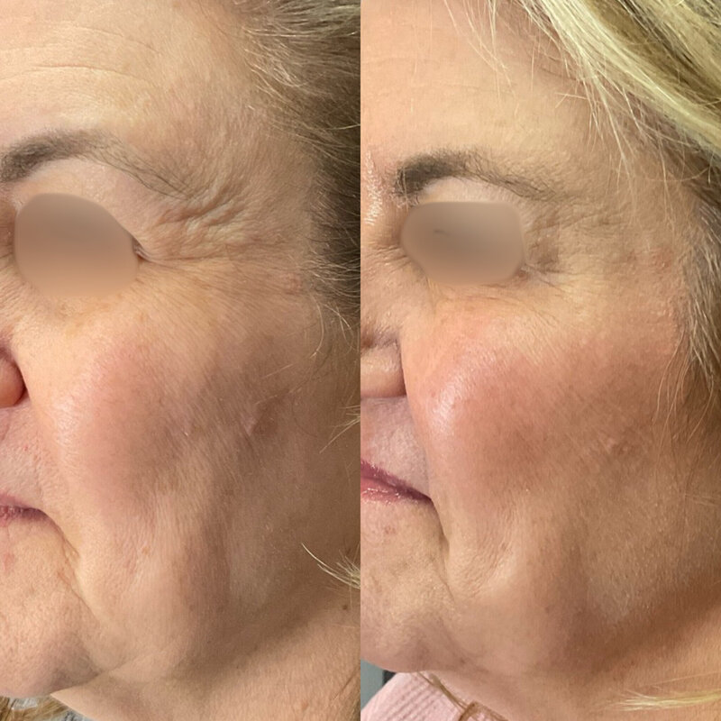 Before and after photos of Zula Modern Medspa botox treatment patient