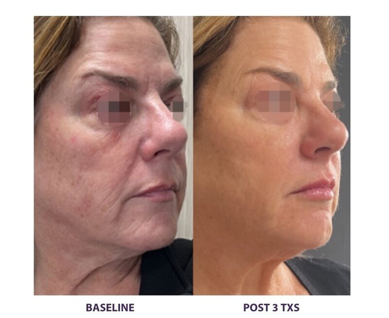 Before and after photos of Zula Modern Medspa anti-aging treatment patient