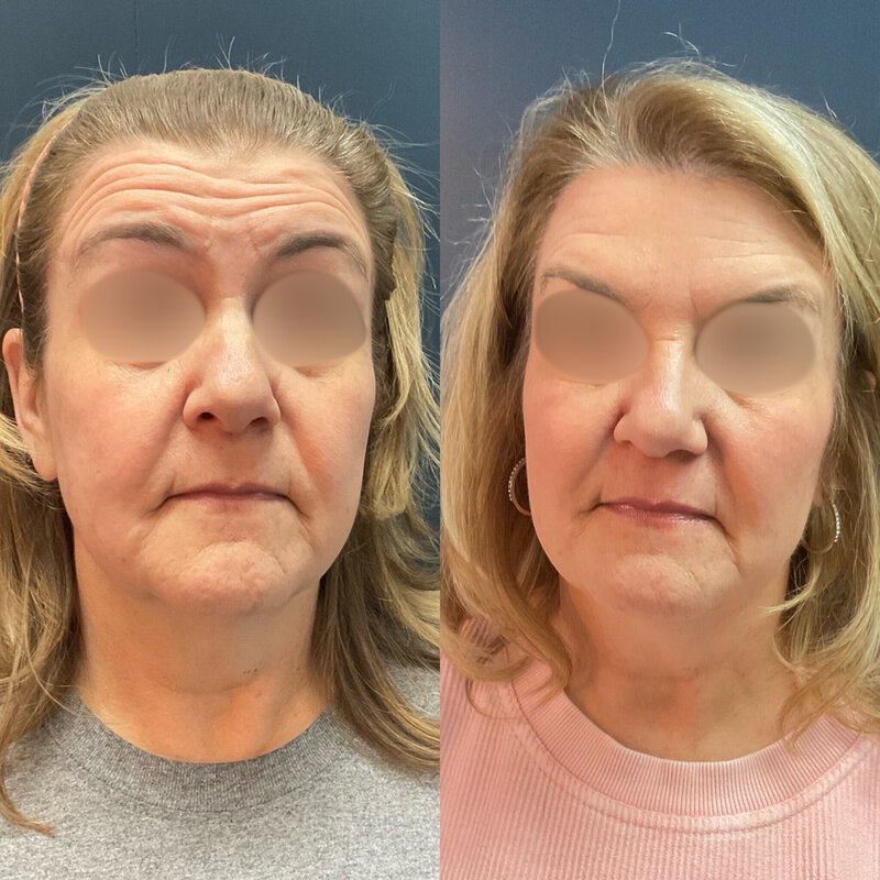 Before and after photos of Zula Modern Medspa botox treatment patient