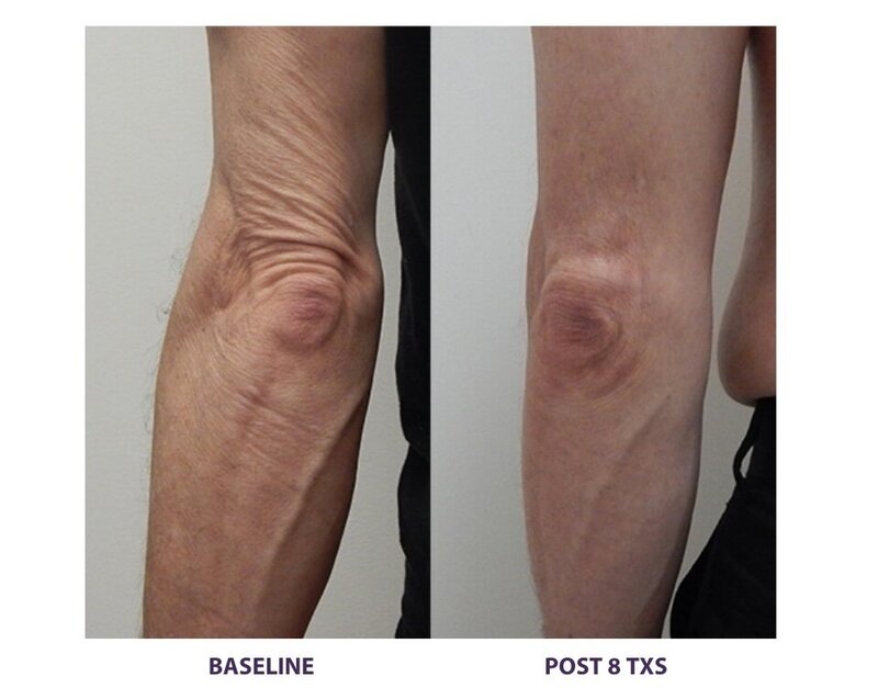 Before and after photos of Zula Modern Medspa fat loss treatment patient