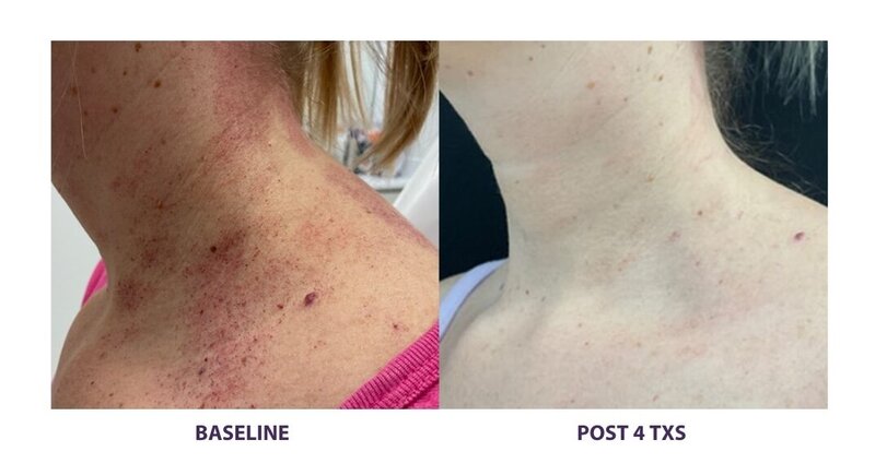 Before and after photos of Zula Modern Medspa rosacea treatment patient